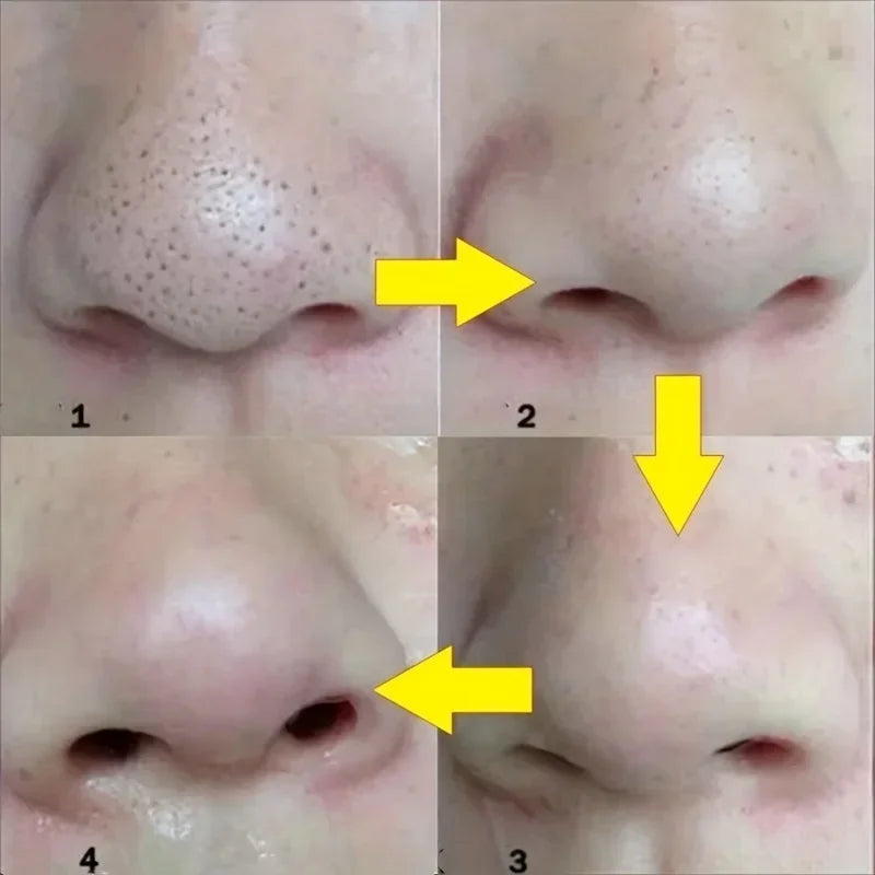 15 Patchs Anti-Points Noirs – Nettoyage en Profondeur du Nez, Masque Purifiant pour Peau à Imperfections et Acné (Idéal Dropshipping)